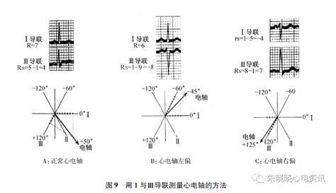 心脏逆钟向转位是什么意思严重吗