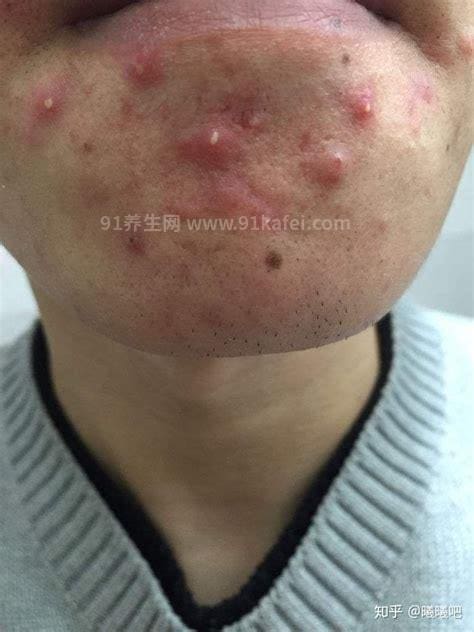 下巴反复长红肿硬硬的痘痘怎么办,药物疗法/饮食疗法/获得充足的睡眠