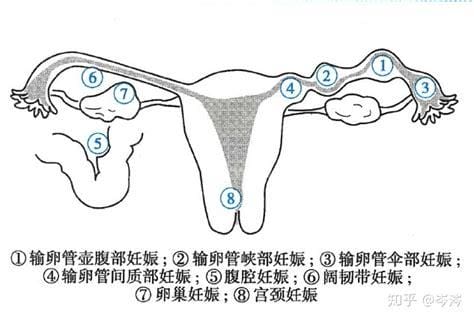 宫外怀孕怎么办 宫外怀孕应该怎么办