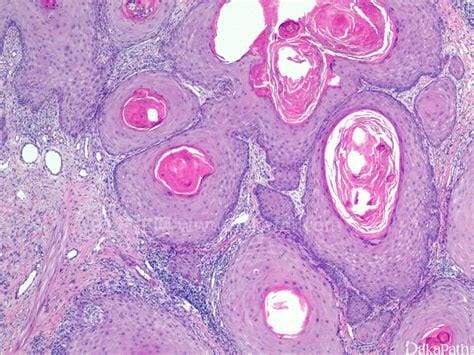 鳞状细胞癌图片