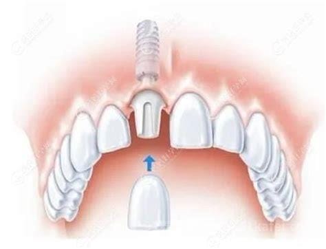 种植牙多少钱一颗2023年，国产2680元起/颗（植牙价格表）优质