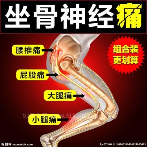 坐骨神经痛的疼点图，单侧腰部到脚底疼（缓解方法）优质