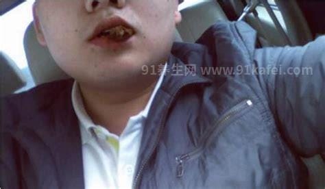 嚼槟榔脸变大怎么恢复，推荐5个小方