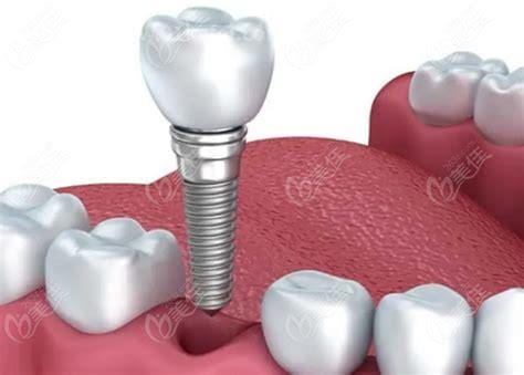 2023种植牙多少钱一颗，6000～30000元每个地区价位有所差异优质