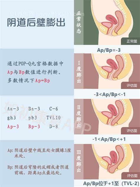 阴壁膨出1度2度3度图片，1度没有明显症状优质