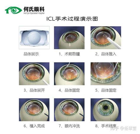 人工晶体植入术的费用一览表2023，瑞士要25000元起优质