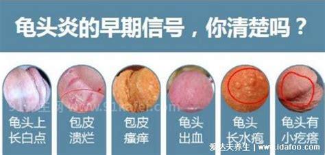 四种类型龟头炎症状图片对照，明显的红色印记说明已经患病了优质