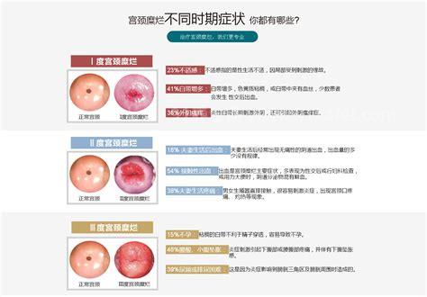 宫颈糜烂一二三度图清晰，，重度小腹会经常隐隐作痛优质