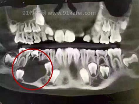 小孩换牙前的颅骨图，深度揭秘换牙过程（胆小勿看）优质
