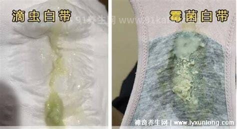 霉菌性阴炎排出物图片，白带呈白色豆