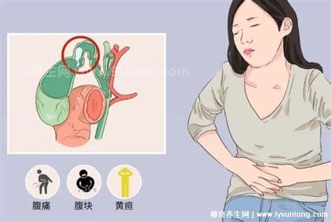 胆囊炎症状疼痛位置图，位于右上腹与