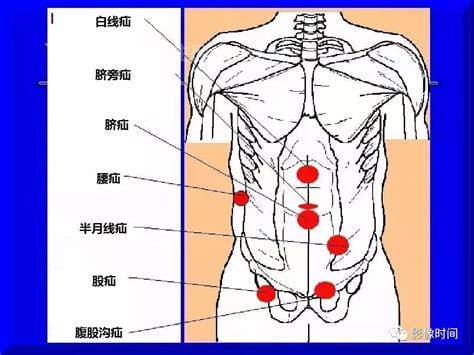 人体腹股沟在哪个位置图片，大腿里侧和腹部之间(两侧三角区域)