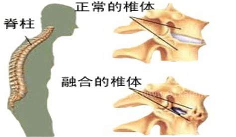 强直性脊柱炎6个地方疼，腰背痛胸痛还有神经痛