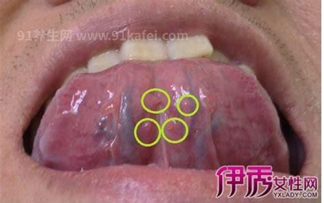 hpv感染舌头的初期图片，警惕红色丘疹/疣体(注意会导致癌变)