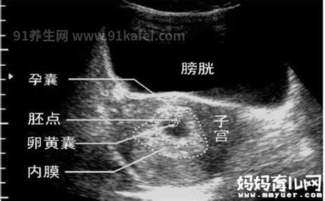 一分钟看懂孕囊大小对照表，生男生女其实看孕囊很准