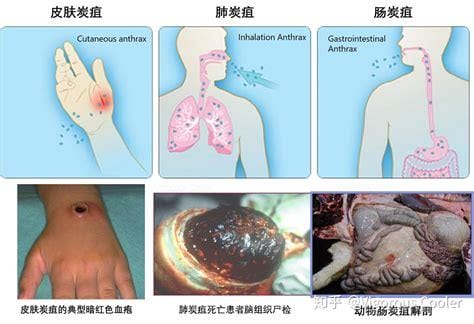 人体皮肤炭疽病图片早期症状，有丘疹水疱会发展成黑痂(身体还发热)