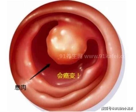 真实宫颈息肉图片早期症状，阴道少量点滴出血/白带异常(3大症状)