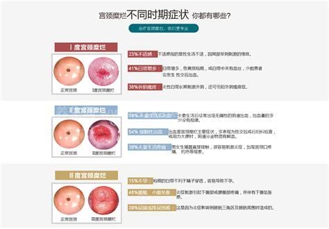 宫颈糜烂一二三度图片及症状，女性一定要重视发展成宫颈癌就晚了