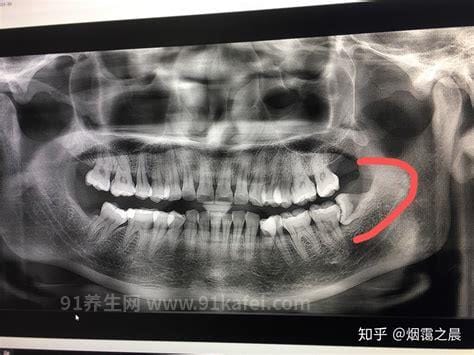 不需要拔的智齿图片，这4种智齿拔了还会后悔