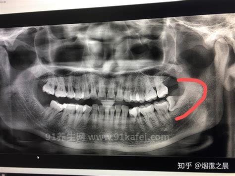 看清不需要拔的智齿图片，可能成为你其他烂牙坏牙的救星