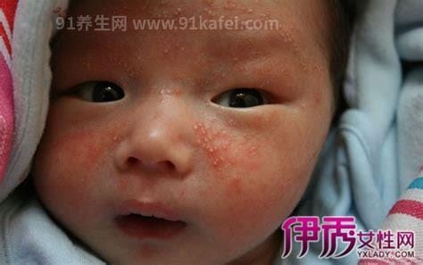 婴儿奶癣是什么样子的图片，就是湿疹有3种类型注意区分(附护理法)