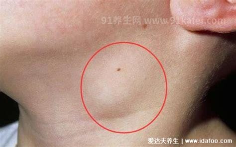 癌症前期的18种预兆和图片，常见的乳