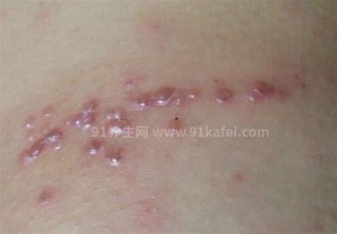 带状疱疹图片及初期症状，多为不对称带状小水泡疼痛感强烈