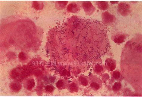 细菌性阴炎的主要症状图片，灰白色稀薄状白带有鱼腥味(4大症状)