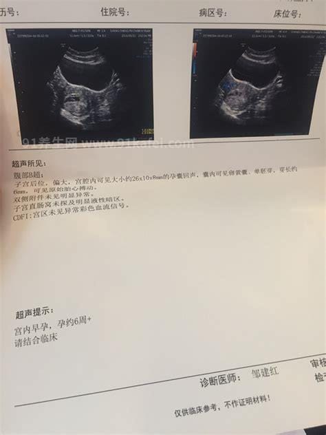 孕囊大小对照表看男女，怀孕10周小于2.83cm要小心流产