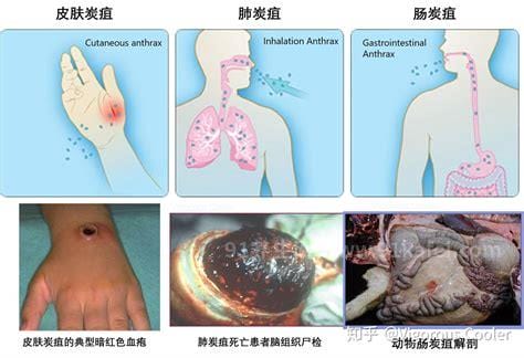 人感染皮肤炭疽病有多可怕，肺炭疽从发病到死亡只有两天(图片)