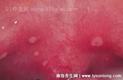 疱疹性咽峡炎五个分期图片，口腔有灰白色疱疹/潜伏期传染性最强