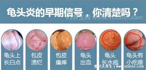 四种类型龟头炎症状图片对照，有红点丘疹会扩散发展成溃疡