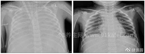 白肺的一个明显表现是气紧，氧饱和度低于93%需要去医院