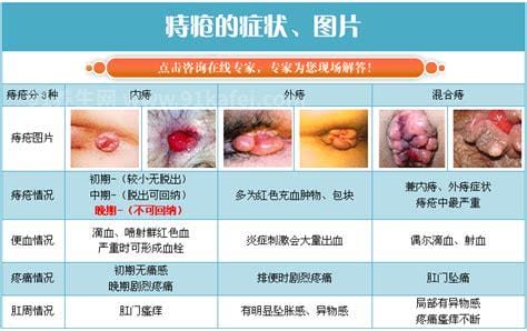 不同程度的内痔疮图片，一般不严重但严重的必须手术切除