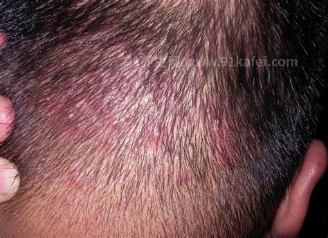 毛囊炎的症状和图片，头部的小脓疱痊愈后留下秃发斑