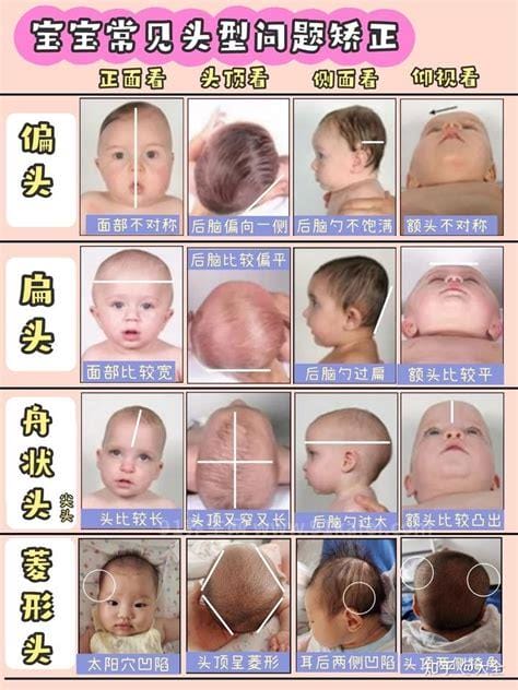婴儿方颅图片和正常对比头型图片，上至下看前额突(正常：圆弧无棱角)