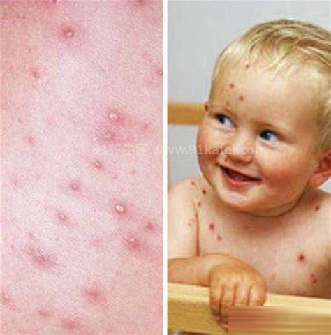 水痘初期症状图片，头躯干先出/数小时丘疹变为疱疹(先发热)