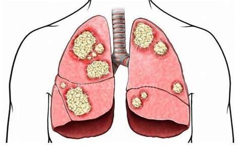 警惕肺癌的15个征兆，从早期到晚期只需几个月的时间
