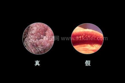 男女性尖疣湿早期症状图片，在初期出现淡红色丘疹(可呈鸡冠菜花状)