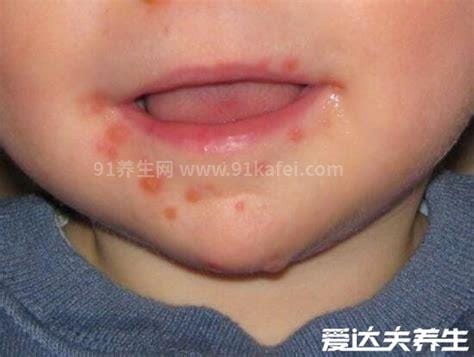 小儿手足口病最早期图片，先在嘴巴发