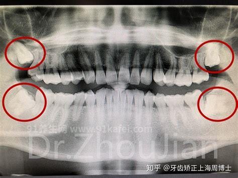 不需要拔的智齿图片，长相端正还可以增加咬合力