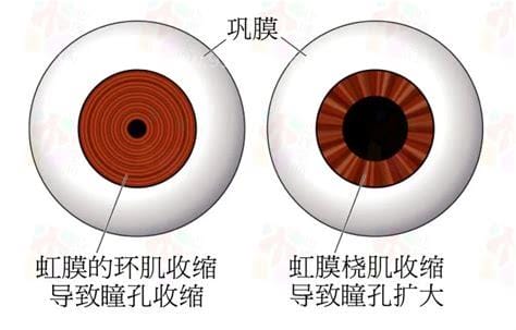 正常瞳孔和瞳孔放大图，非正常对光反