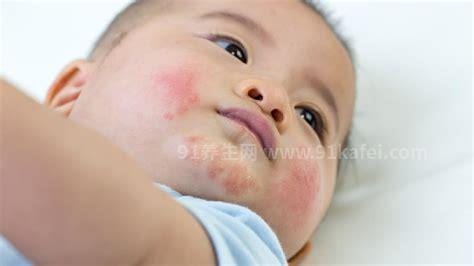 6种常见新生婴儿皮肤红疹图片，超详