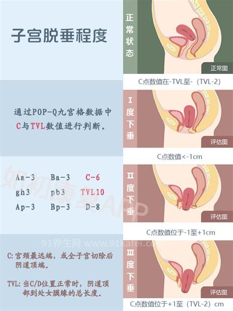 阴壁膨出1度2度3度图片，能摸到膨出的小肉球(4大症状)