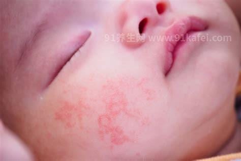 新生儿湿疹图片症状及护理方法，呈明显红肿有强烈瘙痒感