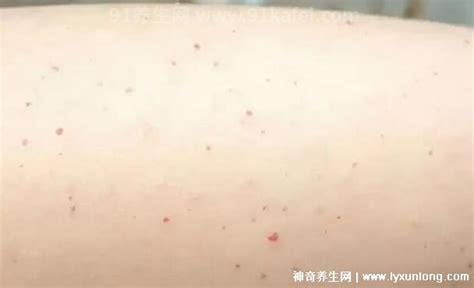 白血病初期小红点图片，警惕紫红色瘀斑或丘疹结节(附早期症状)