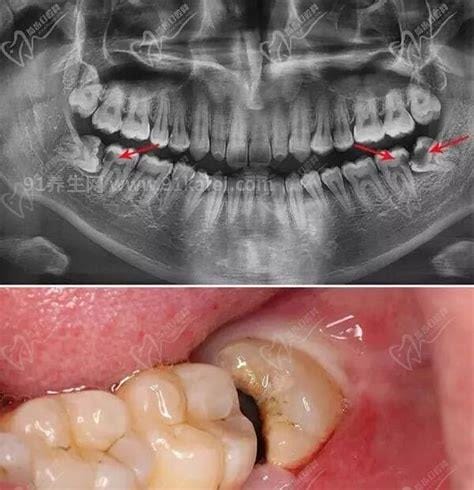 埋伏牙一定要拔吗有什么危害，建议拔除有三大危害(附不需要拔的智齿图片)