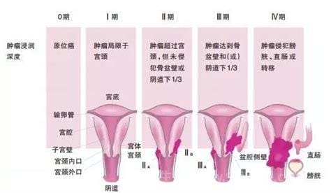 早期宫颈癌的六个信号，三处痒两处不适(分泌物异常)