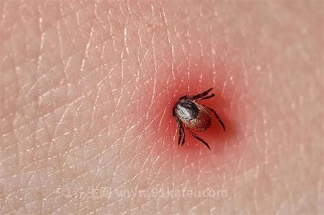 蜱虫咬人后的伤口图，出现红肿瘀斑或是黑痣样(严重会丧命)