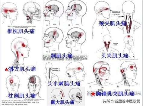 18个痛点的准确位置图，教你寻找全身